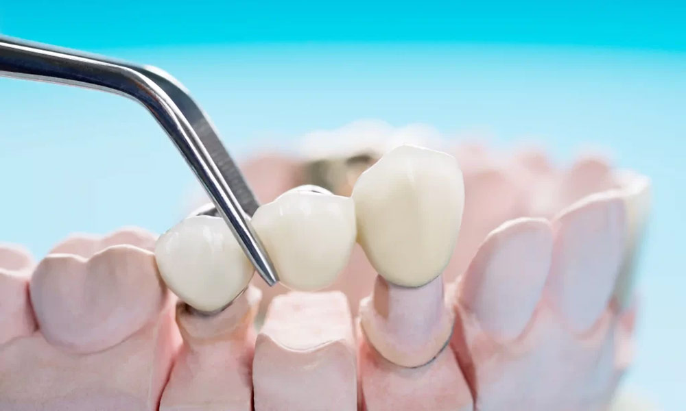 Crowns cover damaged teeth entirely, while bridges can restore teeth that are missing.